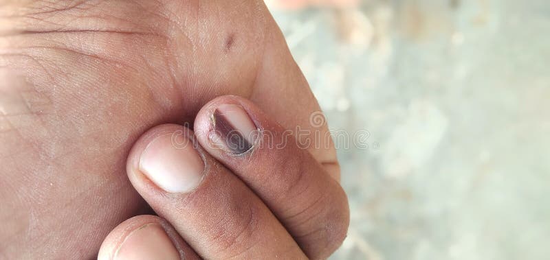 Nail Melanoma Stock Photos - Free & Royalty-Free Stock Photos from Dreamstime Nail Melanoma Stock Photos - Free & Royalty-Free Stock Photos from Dreamstime
