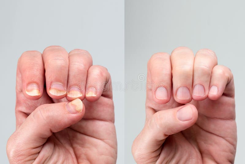 Before and after Successful Treatment for a Onychomycosis or Fungal Nail Infection on Damaged Nails after Gel Polish Stock Photo - Image of disease, medical: 216597144 Before and after Successful Treatment for a Onychomycosis or Fungal Nail Infection on Damaged Nails after Gel Polish Stock Photo - Image of disease, medical: 216597144