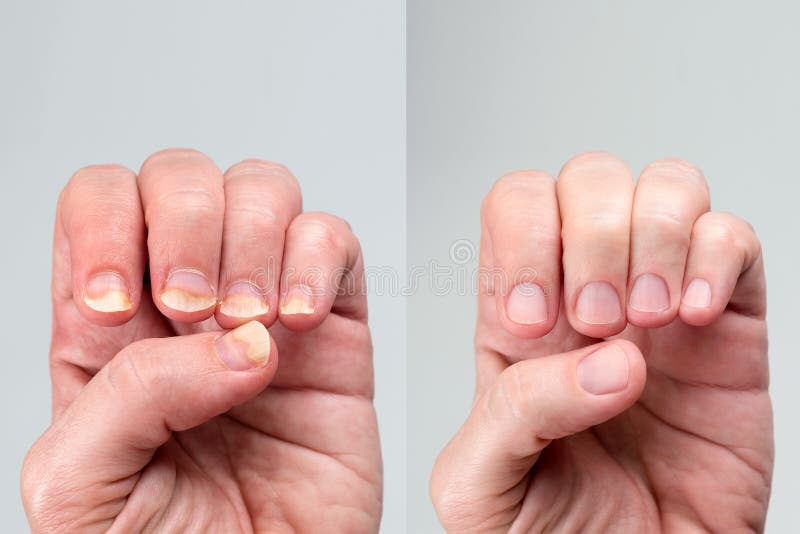 An Atlas of Nail Disorders, Part 15   Consultant360