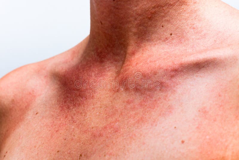 Close up of female sunburnt skin neck with allergic reaction. Close up of female sunburnt skin neck with allergic reaction.