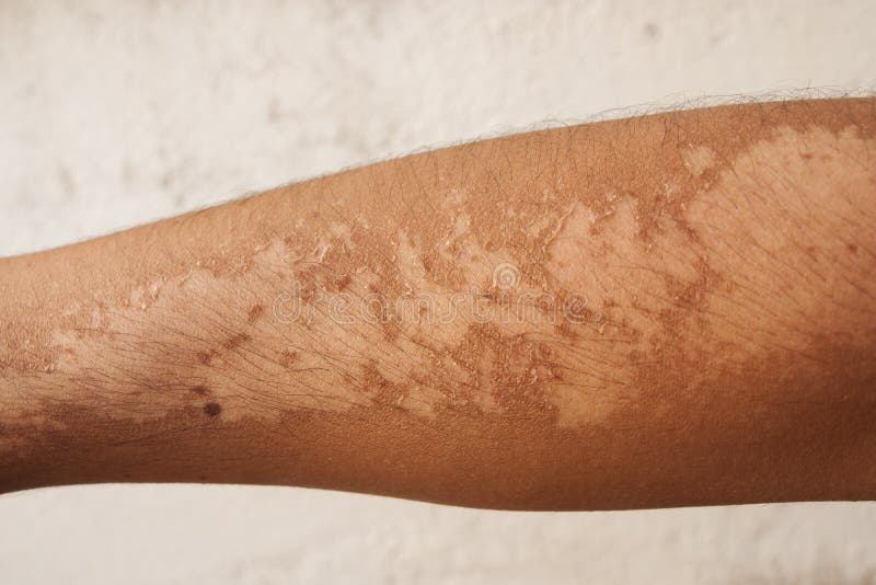 Sunburn Effects stock photo. Image of painful, body, detail 57457604