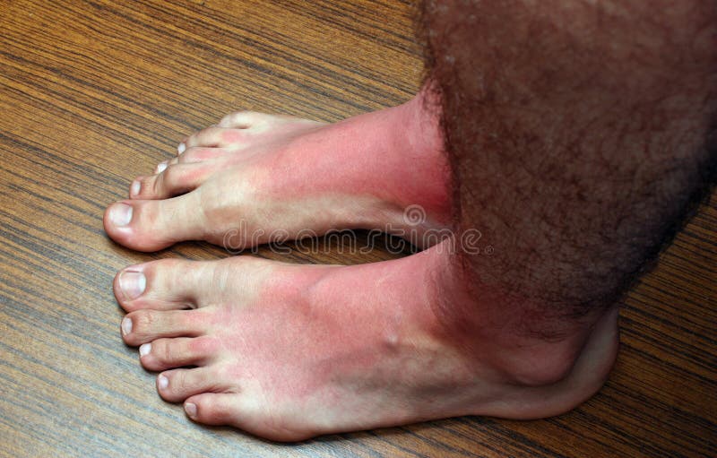 Sunburn feets stock photo. Image of holiday, ozone, brown 33278090