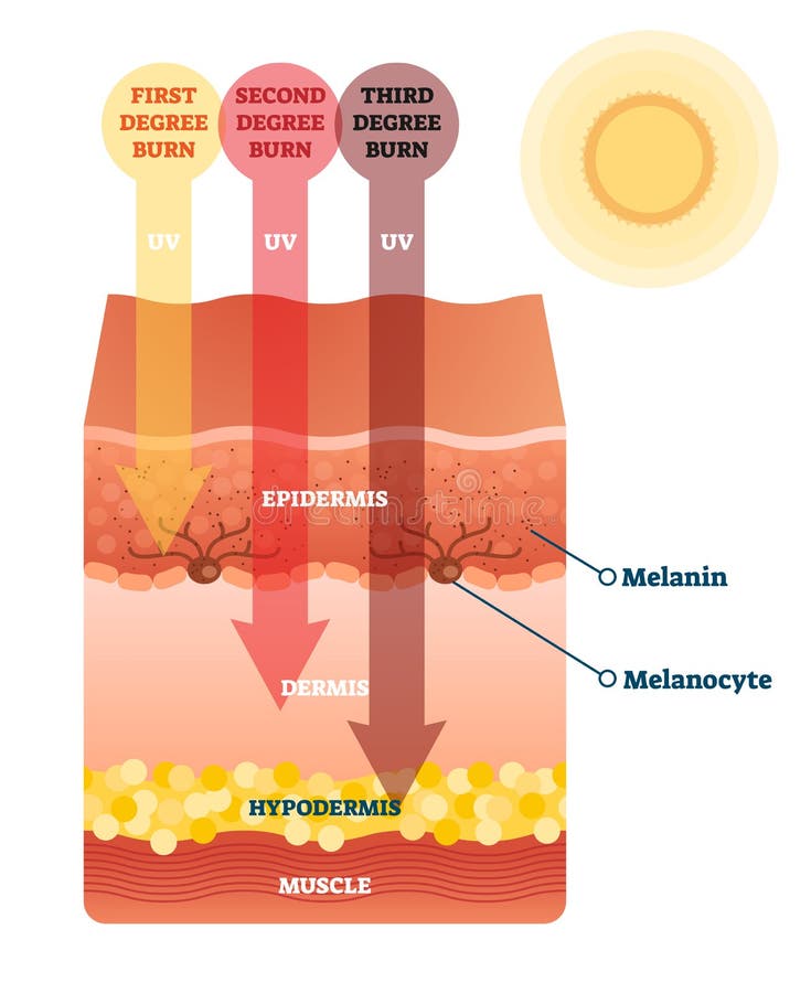 Sunburn Skin Damage Anatomical Cross Section Diagram Stock Vector