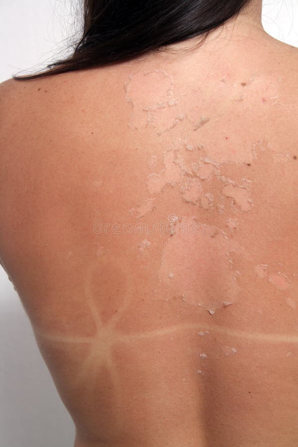 Peeling Sunburned Back stock image. Image of ozone, back 16252339