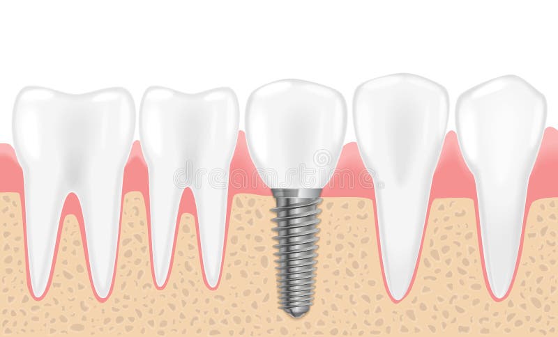Sunda tänder och tand- implantat Realistisk vektorillustration av tandläkarundersökningtandläkekonst Tand- mänskliga tänder stock illustrationer Sunda tänder och tand- implantat Realistisk vektorillustration av tandläkarundersökningtandläkekonst Tand- mänskliga tänder stock illustrationer
