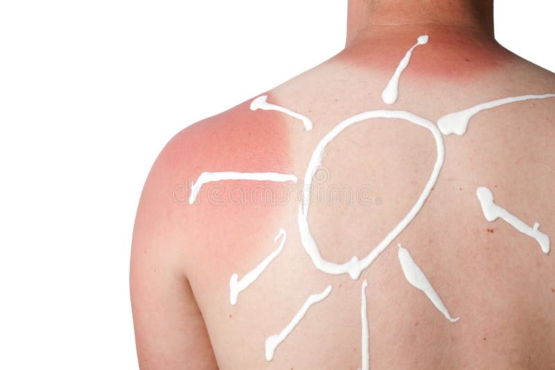 Skin cancer stock photo. Image of damage, pain, consequence 13946326