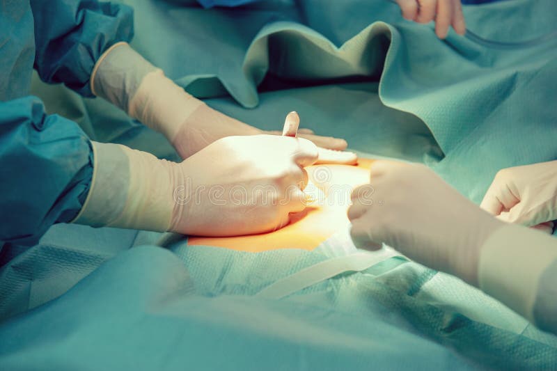 Surgeons working on a patient stock photo Surgeons working on a patient stock photo