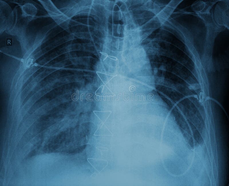 After Surgery Xray of Patient with Suture Stock Photo Image of body