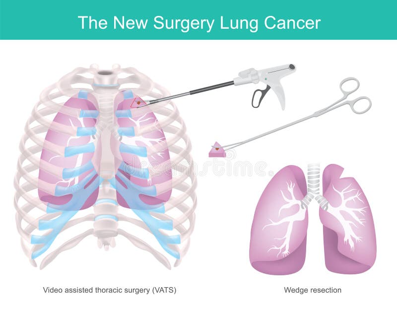 Lung Resection Stock Illustrations 170 Lung Resection Stock