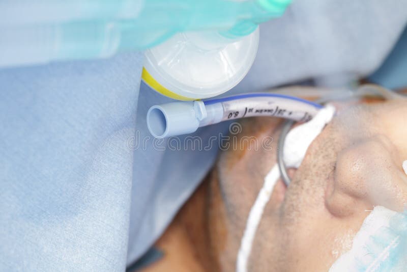 Surowi pacjenci z endotracheal tubką zdjęcia stock Surowi pacjenci z endotracheal tubką zdjęcia stock