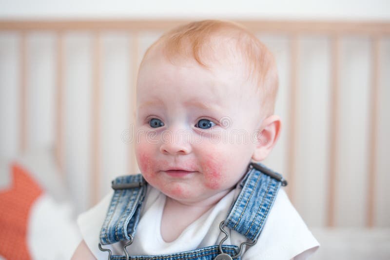 Child with atopic dermatitis