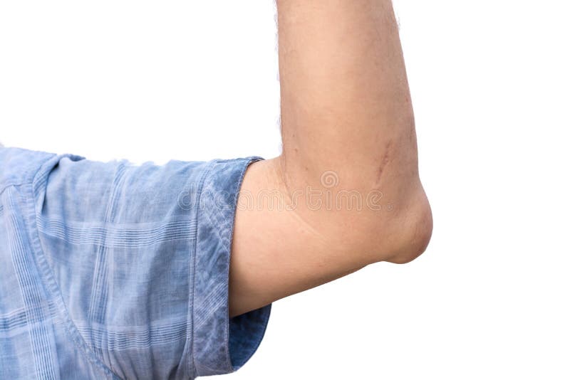 Swollen Elbow by Inflamed Joint in Front of White Background Stock
