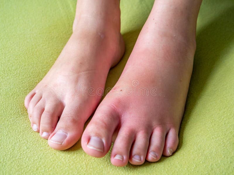 Swollen Foot after an Insect Bite Stock Photo Image of inflammation