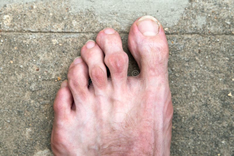 Swollen Joint on the Toe. Rheumatoid Arthritis Stock Photo Image of disease, painful 227801932
