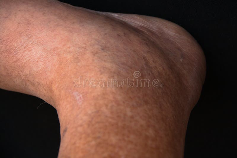 Swollen left ankle of 79-year old white male. stock image