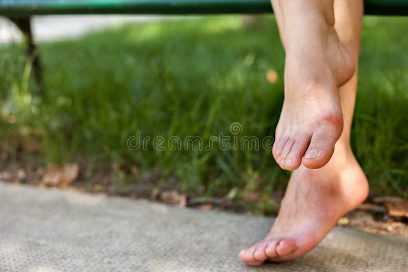 Swollen tired feet stock image. Image of ankle, ache 80186585