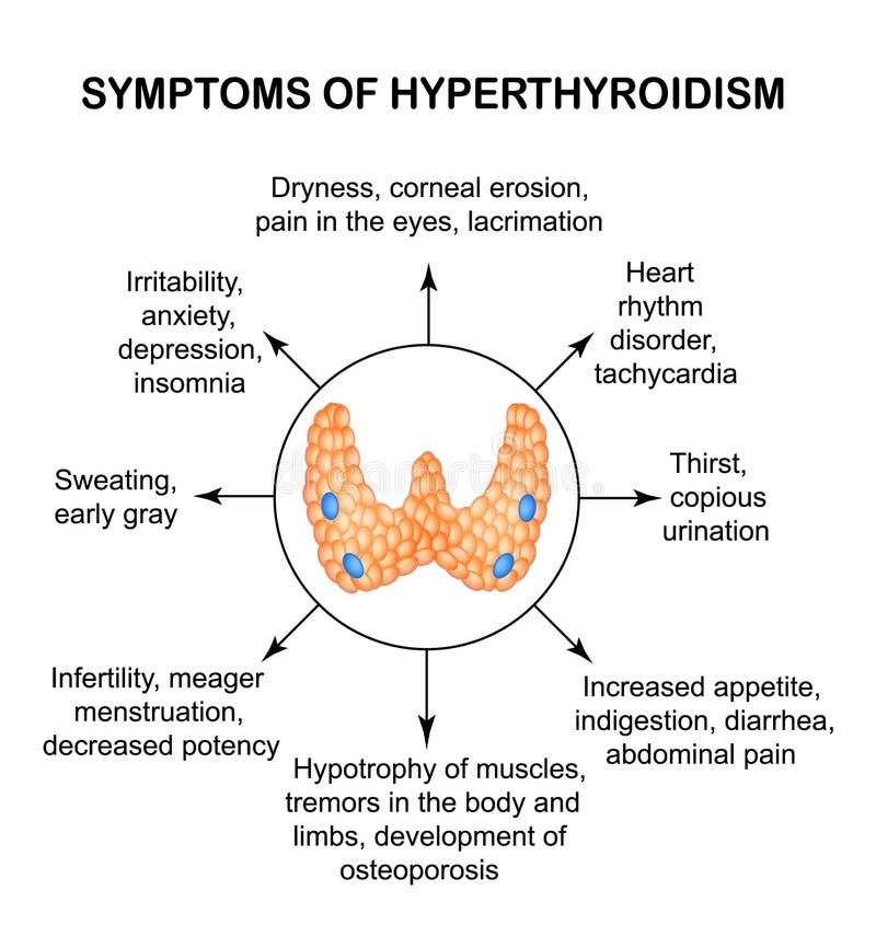 Symptoms of hyperthyroidism. Thyroid. Infographics. Vector illustration on isolated background. Symptoms of hyperthyroidism. Thyroid. Infographics. Vector illustration on isolated background