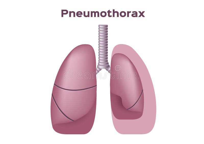 Pneumothorax Stock Illustrations – 279 Pneumothorax Stock Illustrations, Vectors & Clipart - Dreamstime Pneumothorax Stock Illustrations – 279 Pneumothorax Stock Illustrations, Vectors & Clipart - Dreamstime