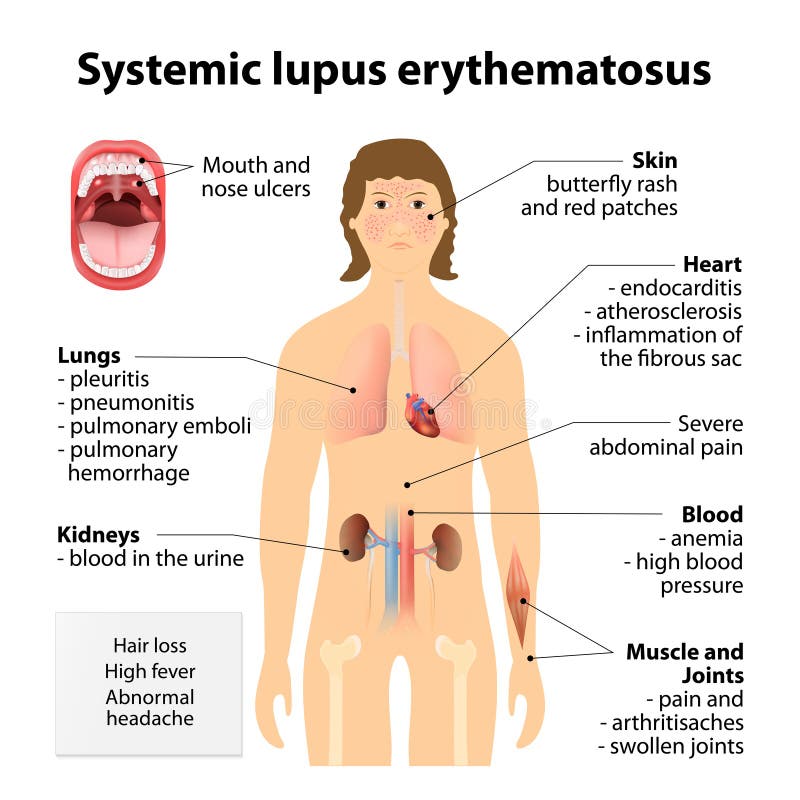 Systemic lupus erythematosu royalty free illustration Systemic lupus erythematosu royalty free illustration