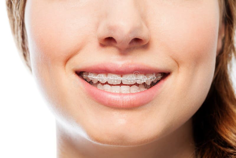 Szczęśliwy kobiety ` s uśmiech z ortodontycznymi jasnymi brasami