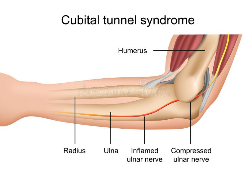 Síndrome cubital del túnel, ejemplo médico inflamado del vector del nervio cubital en el fondo blanco