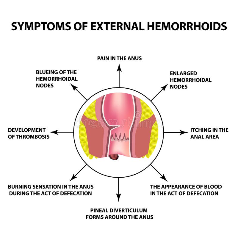 Síntomas de hemorroides externos El nodo hemorroidal en el recto, ano Infografía Ilustración del vector ilustración del vector Síntomas de hemorroides externos El nodo hemorroidal en el recto, ano Infografía Ilustración del vector ilustración del vector
