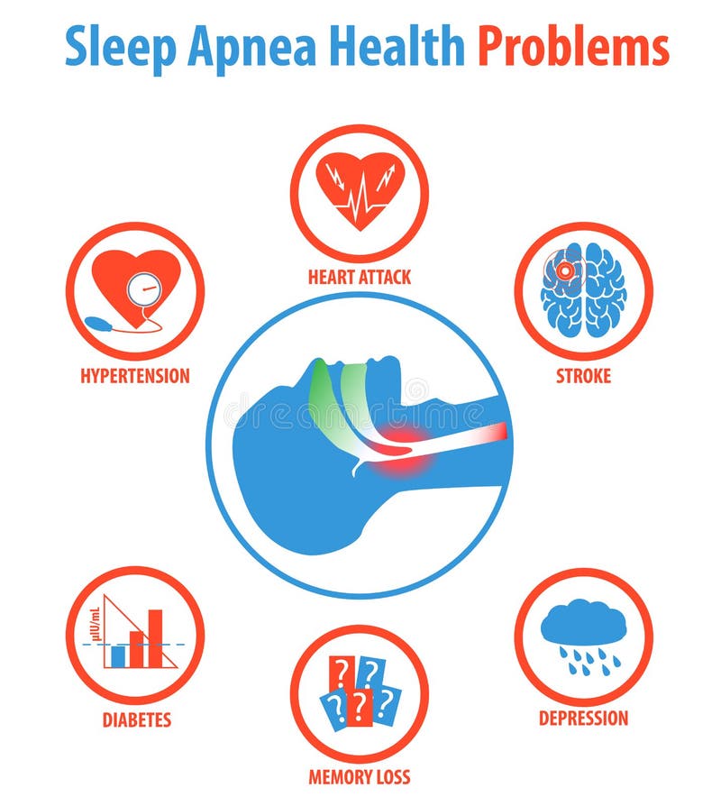 Sleep apnea: treatments, causes, symptoms and health problems. Vector Illustration. Sleep apnea: treatments, causes, symptoms and health problems. Vector Illustration.