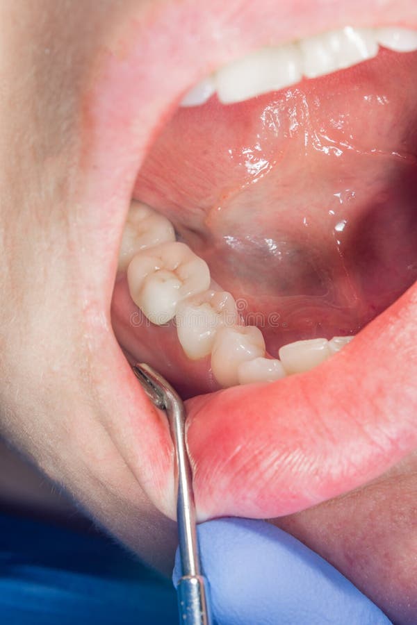 Tand de keramiekclose-up van het kroonmetaal in de mond van de patiënt in de tandkliniek Het concept prosthetics met gebruiksimpl stock afbeelding Tand de keramiekclose-up van het kroonmetaal in de mond van de patiënt in de tandkliniek Het concept prosthetics met gebruiksimpl stock afbeelding