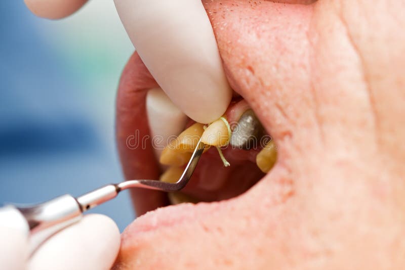 tand- gingival placerande sulcus för kabel royaltyfria foton tand- gingival placerande sulcus för kabel royaltyfria foton
