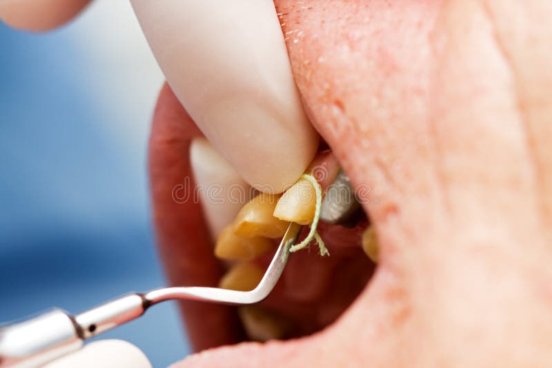 tand- gingival placerande sulcus för kabel royaltyfria foton tand- gingival placerande sulcus för kabel royaltyfria foton