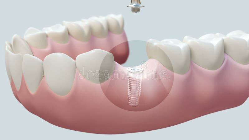 Tand Helder Implant