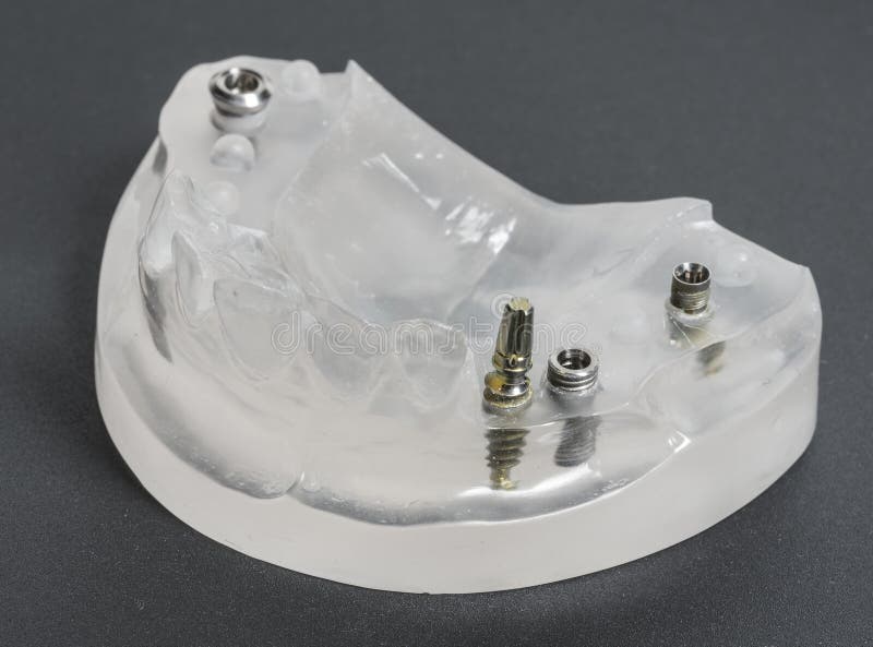 tand- implantatmedicinstomatology arkivfoton tand- implantatmedicinstomatology arkivfoton
