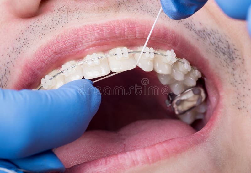 Tandläkarelokalvårdtänder med keramiska konsoler, genom att använda floss på det tand- kontoret Makro som skjutas av tänder med h arkivbilder Tandläkarelokalvårdtänder med keramiska konsoler, genom att använda floss på det tand- kontoret Makro som skjutas av tänder med h arkivbilder