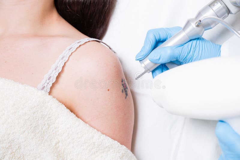 Tatuaggio che rimuove laser immagine stock Tatuaggio che rimuove laser immagine stock
