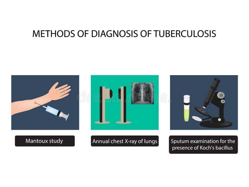 TB kenmerkende methodes Röntgenstralen van licht Het Onderzoek van de Mantouxtest van sputum De Dag van de wereldtuberculose Info stock illustratie TB kenmerkende methodes Röntgenstralen van licht Het Onderzoek van de Mantouxtest van sputum De Dag van de wereldtuberculose Info stock illustratie