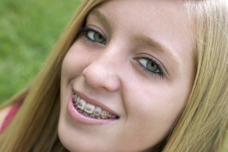 Braces Girl Stock Photo Image Of Happiness Happy