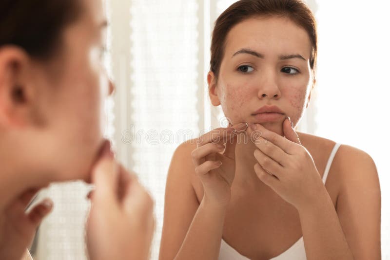 Teen girl with acne problem squeezing pimple near mirror