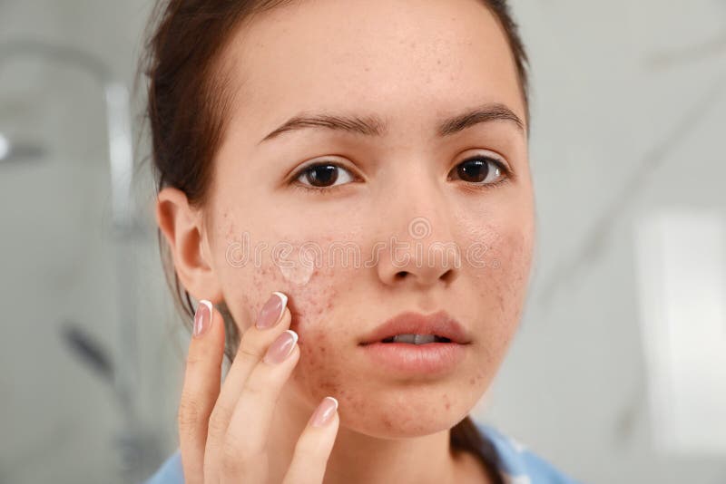 Teen girl applying acne healing patch indoors