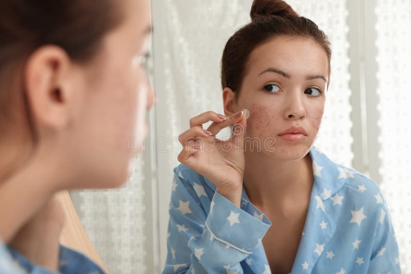 Teen girl applying acne healing patch near mirror