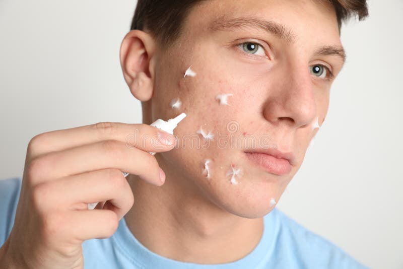 Teen guy with acne problem applying cream on light background, closeup. Teen guy with acne problem applying cream on light background, closeup