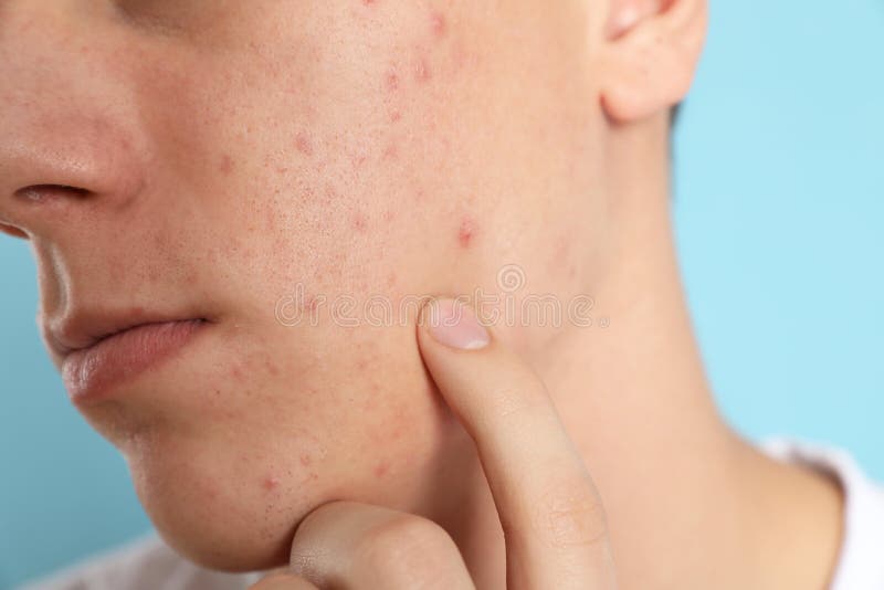 Teen guy with acne problem on light blue background, closeup