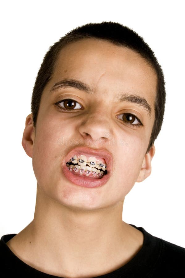 Teenage Shows His Dental Braces Stock Photos Free & RoyaltyFree