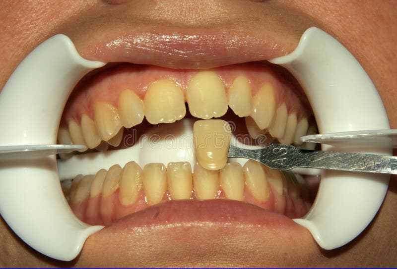 Dental patient about to undergo tooth whitening procedure. Dental patient about to undergo tooth whitening procedure