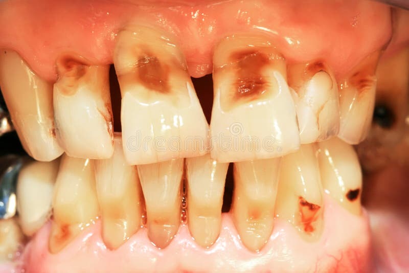 Teeth abrasion stock image. Image of smoke, pathology ...