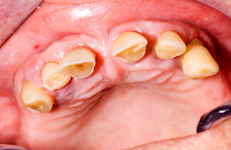 Teeth abrasion stock photo. Image of clinic, tooth, uncared 28859070