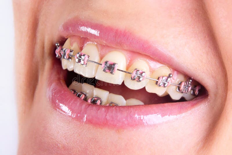 Teeth with braces