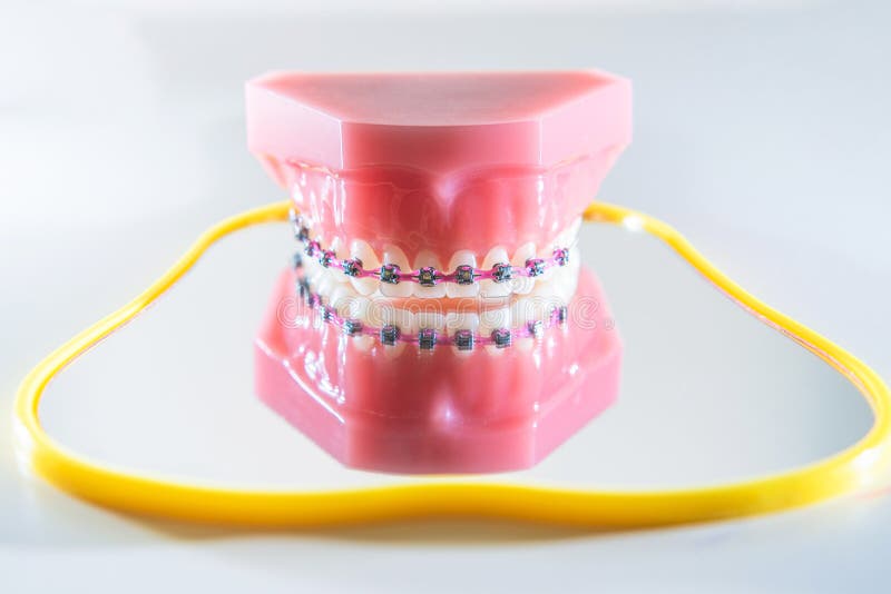 Teeth Braces in the Artificial Jaw on the Mirror. Closeup Stock Image