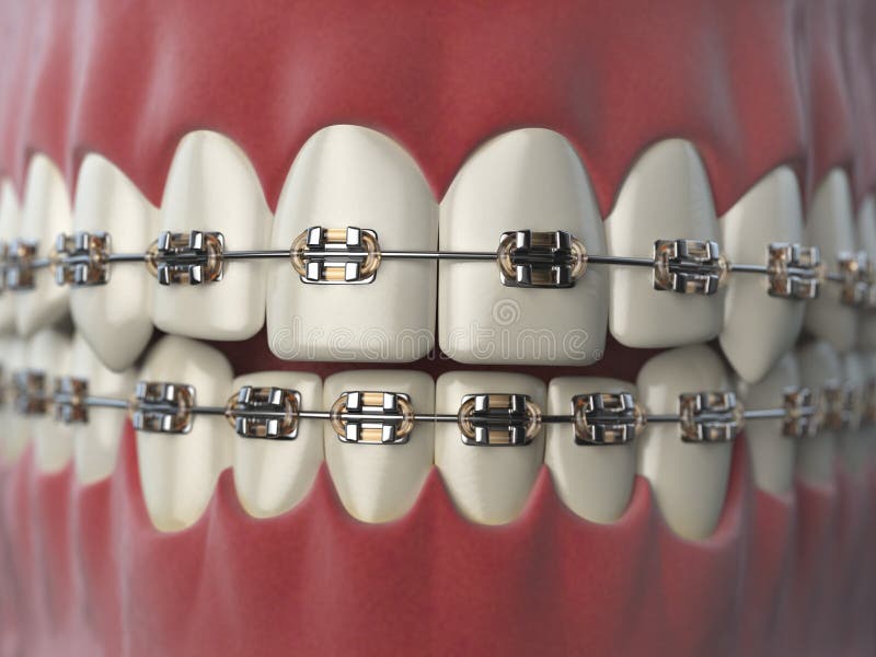 braces brackets braces brackets