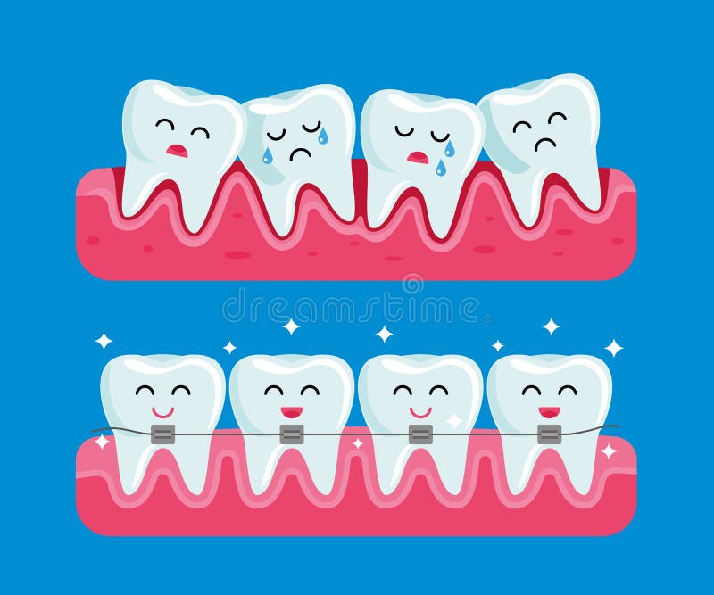 Teeth before and after Braces. Funny Dental Illustration in Cartoon Style Stock Illustration - Illustration of healthy, hospital: 203609951 Teeth before and after Braces. Funny Dental Illustration in Cartoon Style Stock Illustration - Illustration of healthy, hospital: 203609951