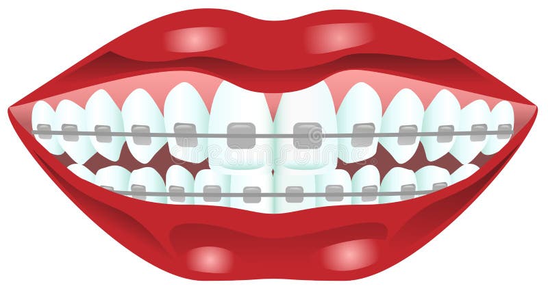 Teeth with braces stock vector. Illustration of vector - 33550130